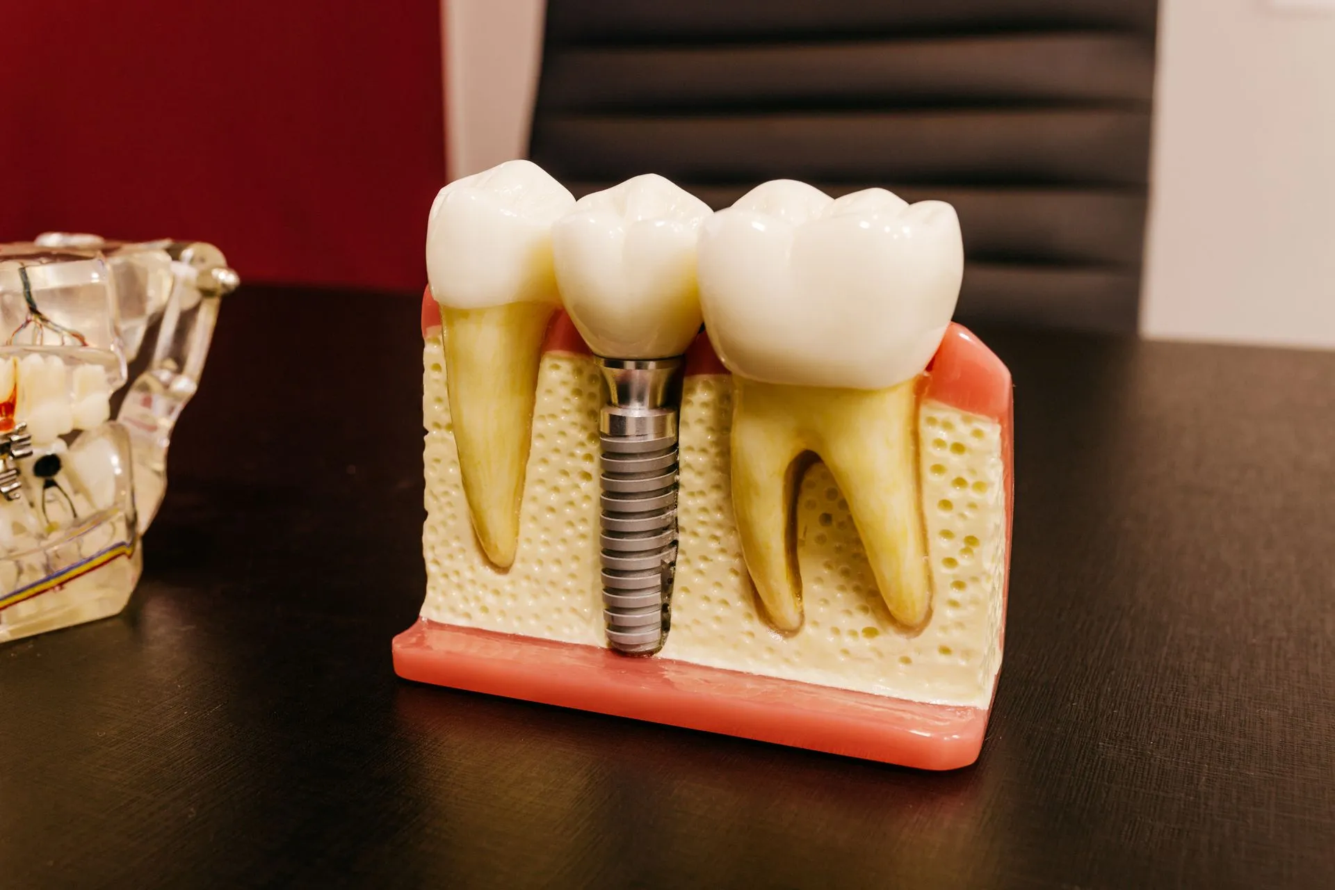 Modelo dental mostrando un implante con tornillo y corona junto a los dientes naturales